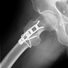 Osteosynthese Abrissbruch des großen Rollhügels (Trochanter major) re.