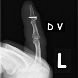 Knöcherner Strecksehnenausriss des Kleinfingers