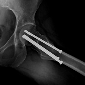 Osteosynthese eines körpernahen Schenkelhalsbruches (mediale Schenkelhalsfraktur) li.