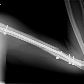 Osteosynthese eines Oberarmschaftbruches (Humerusschaftfraktur) li.