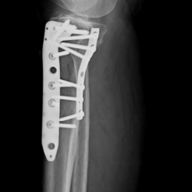 Osteosynthese eines Schienbeinkopfbruches (Tibiakopffraktur) re. 