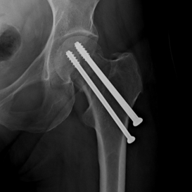 Osteosynthese Abrissbruch des großen Rollhügels (Trochanter major) re.