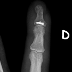 Knöcherner Strecksehnenausriss des Kleinfingers