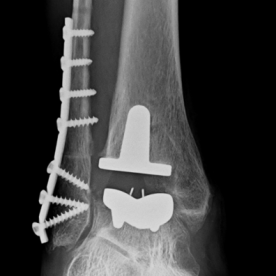 Obere Sprunggelenksprothese