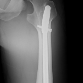 Osteosynthese eines Oberschenkelschaftbruches li. mit Marknagel (Femurfraktur)
