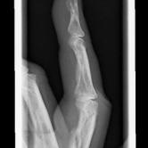 Verschobener Grundgliedbruch (dislozierte Fraktur der proximalen Phalanx) li. Zeigefinger bei einem Erwachsenen