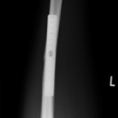 Osteosynthese eines Ellenschaftbruches (Ulnaschaftfraktur) li. 