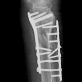 Osteosynthese eines Ellenbruches und eines Speichenbruches (Ulnafraktur und Radiusfraktur) re.