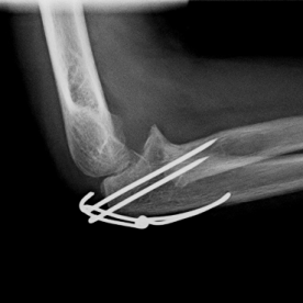 Osteosynthese eines Ellenhakenbruches (Olecranonfraktur) li.