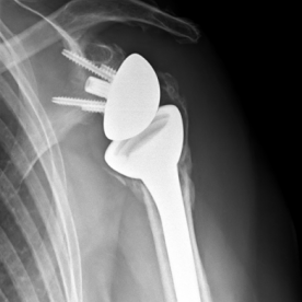 Schultertotalendoprothese li. (sogenannte inverse Prothese)