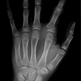 Verschobener Grundgliedbruch (dislozierte Fraktur der proximalen Phalanx) li. Zeigefinger bei einem Kind