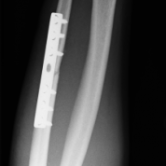 Osteosynthese eines Ellenschaftbruches (Ulnaschaftfraktur) li. 