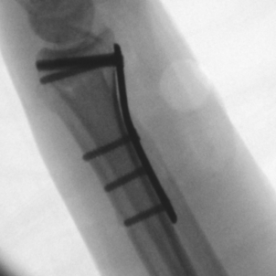 Osteosynthese eines körperfernen Speichenbruches (distale Radiusfraktur) li.