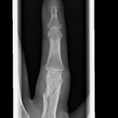 Verschobener Grundgliedbruch (dislozierte Fraktur der proximalen Phalanx) li. Zeigefinger bei einem Erwachsenen