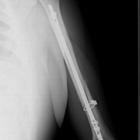 Osteosynthese eines Oberarmschaftbruches (Humerusschaftfraktur) li.