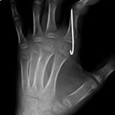 Osteosynthese der Fraktur und Fixierung mittels Draht