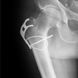 Osteosynthese Abrissbruch des großen Rollhügels (Trochanter major) re.