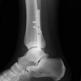 Osteosynthese eines Außenknöchelbruches (Fibulafraktur) mit Riss des Syndesmosenbandes li.