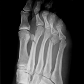 Osteosynthese bei Mittelfußknochenbrüchen 2-4 (Metatarsale-2-4 Fraktur) re.