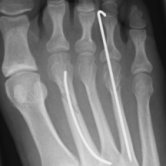 Osteosynthese bei Mittelfußknochenbrüchen 2-4 (Metatarsale-2-4 Fraktur) re.
