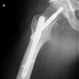 Osteosynthese eines pertrochantären Oberschenkelbruches re. (pertrochantäre Femurfraktur)