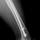 Osteosynthese eines Oberschenkelschaftbruches li. mit Marknagel (Femurfraktur)