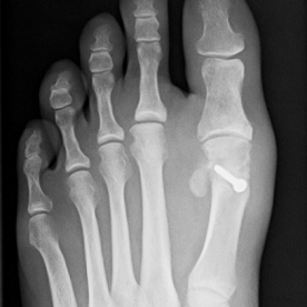 Korrigierende Umstellung des 1. Mittelfußknochens bei Hallux valgus li.