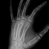 Verschobener Grundgliedbruch (dislozierte Fraktur der proximalen Phalanx) li. Zeigefinger bei einem Kind