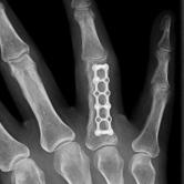 Osteosynthese der Fraktur mittels Platte