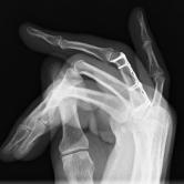 Osteosynthese der Fraktur mittels Platte