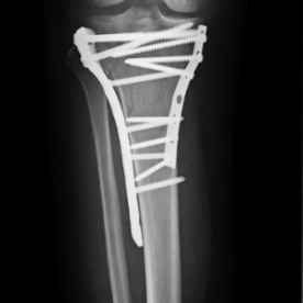 Osteosynthese eines Schienbeinkopfbruches (Tibiakopffraktur) re. 